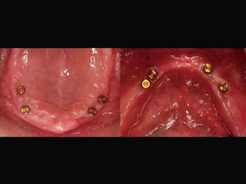 2. Place Implant Into Bone