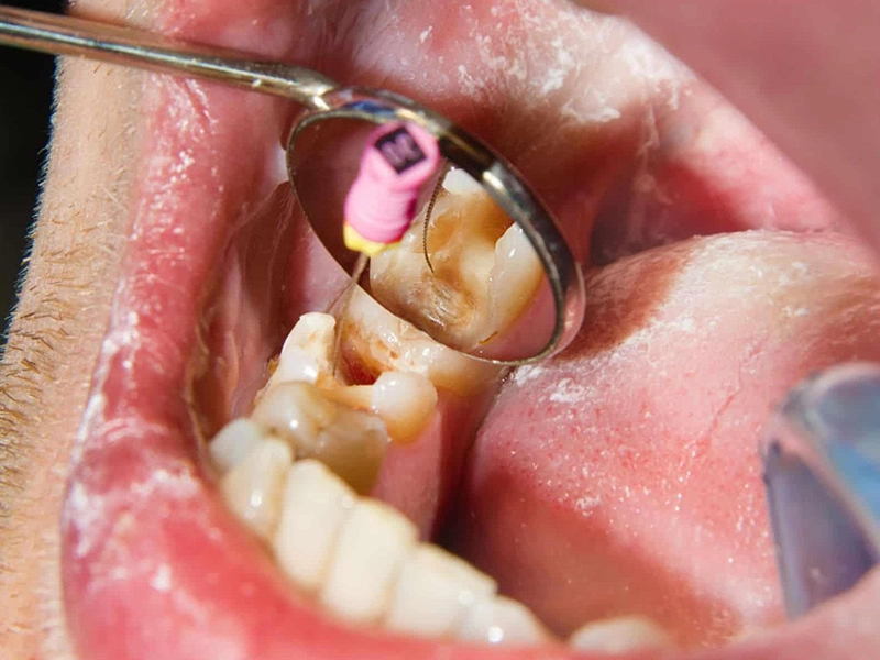 1. Root Canal Treatment