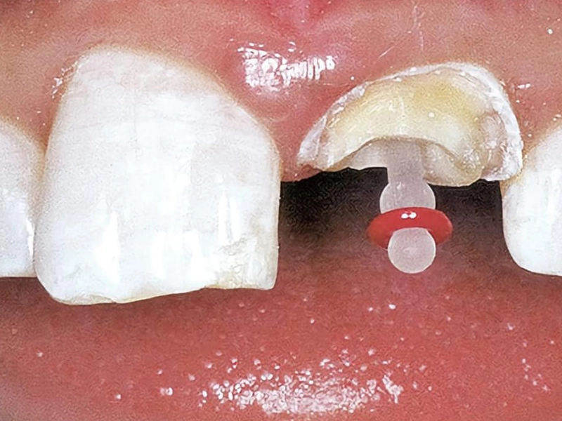 2. Root Post Cementation